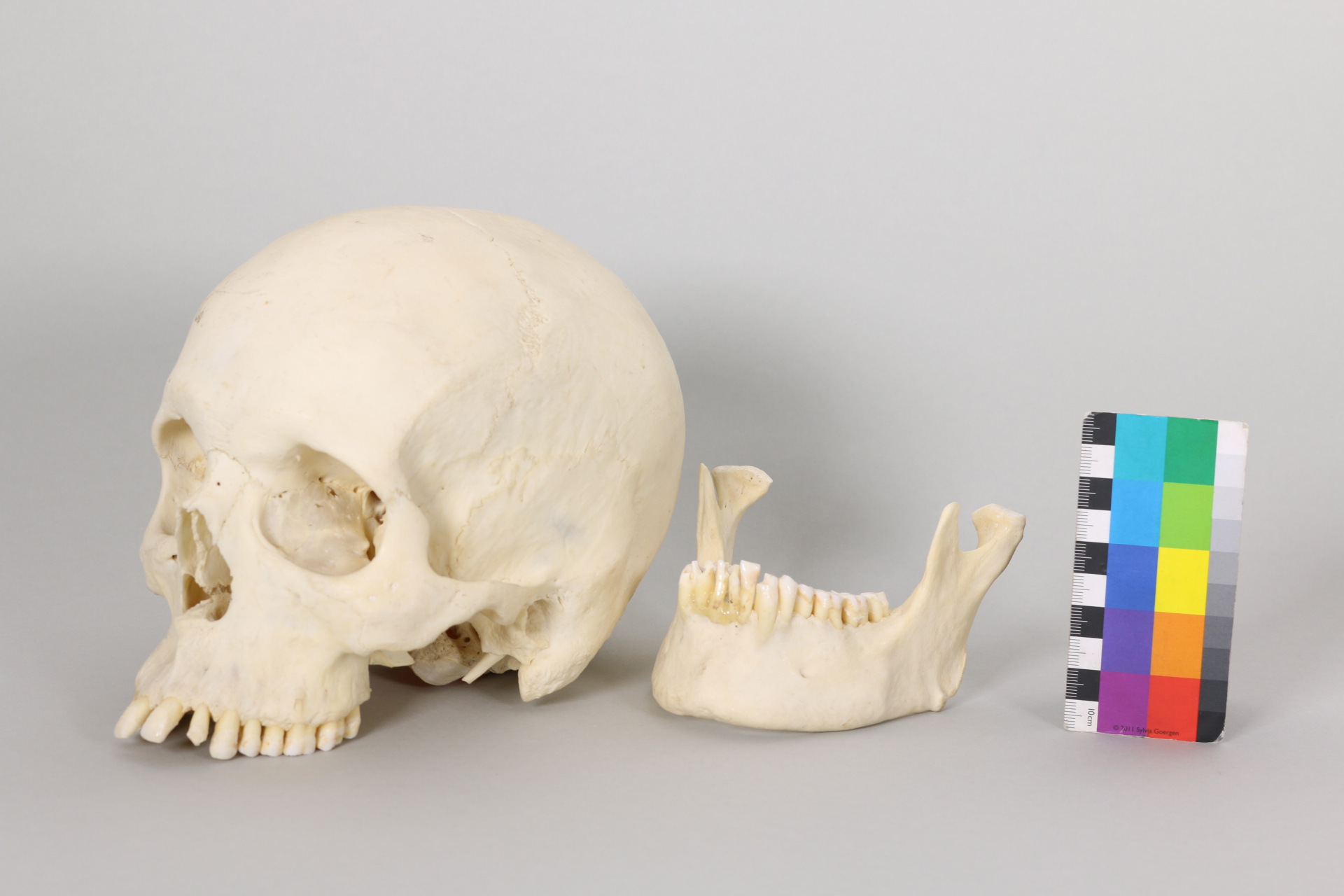 Menschlicher Schädel und Unterkieferknochen auf hellem Hintergrund, daneben eine Farbskala als Größenreferenz.
